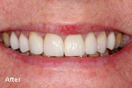 Dental Crowns Before After photos